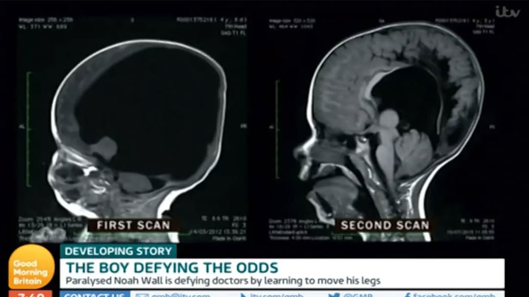 Brain Less Baby Boy Born Without A Brain Defies The Odds By Growing It Back | TOTUM
